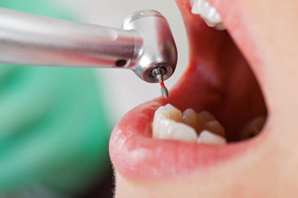 Best Emergency Dental Extractions in Bishopville, SC